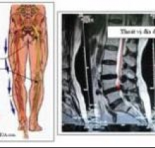 Chấm dứt đau xương khớp - Cột sống